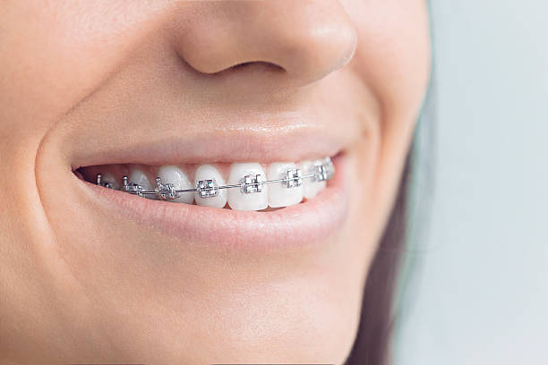 Best Traditional Braces  in Alderwood Manor, WA